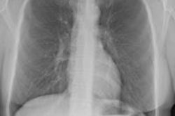 2014 06 06 15 00 47 124 Carestream Bone Suppress 460 20140606220222
