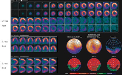 Rb-82 PET rest and stress myocardial perfusion images shown in short-axis, horizontal long-axis, and vertical long-axis views. Corresponding 17-segment polar maps and summed-score maps display the severity of disease detected by automated computer scoring with a normal database. The reversible defect (ischemia) in the inferior wall was associated with significant disease (99% stenosis) in the right coronary artery, as confirmed by invasive angiography. Image courtesy of the University of Ottawa Heart Institute.