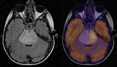 Axial T2 image (left) demonstrates expansile brainstem glioma centered in the pons in a young child. There is increased FDG uptake greater than that of gray matter within the left side of the tumor, representing 25% to 50% of the tumor on the fused PET/MR image (right). Image courtesy of Boston Children's Hospital.