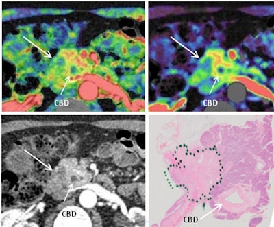Once CTP (upper left) is registered with conventional CT images (lower left) acquired using the interleaved technique, the diagnosis becomes easy owing to the high contrast and delineation of structures, as shown for this patient with classic pancreatic cancer with common bile duct (CBD) involvement. Histology is shown at lower right.
