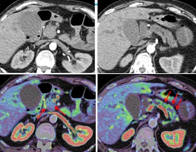 Histology-proven classic adenocarcinoma with infiltration of the duodenum seen in CTP images (bottom row) of a 67-year-old woman presenting with abdominal cramps, weight loss, and jaundice. The lesions are barely visible in conventional CT (top row). All images courtesy of Dr. Mathias Prokop.