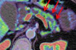 2014 06 11 13 31 11 378 Prokop Adenocarcinoma 450 20140611223344