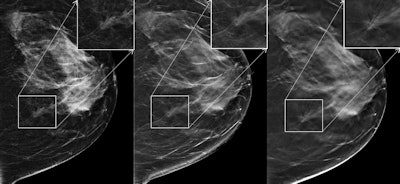 Craniocaudal images in 57-year-old woman with 8-mm invasive ductal carcinoma in the left breast. Left: FFDM image; middle: initial synthesized 2D image; right: DBT image. The region of interest is magnified for each image. Reader scores were 1 for FFDM, 3 for FFDM plus DBT, and 4 for synthesized 2D images plus DBT. This case was from study period 1. All images courtesy of RSNA.
