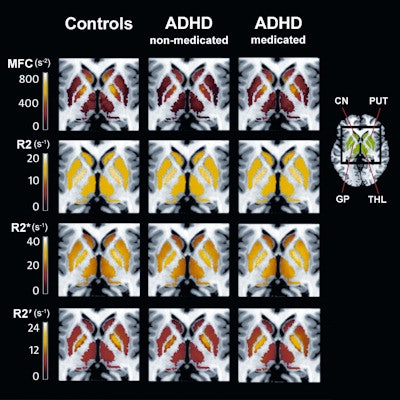 MRI (far right) shows regions of interests (green) in the caudate nucleus (CN), putamen (PUT), globus pallidus (GP), and thalamus (THL) for controls, medication-naive ADHD patients, and ADHD patients with a history of psychostimulant treatment. The ADHD-nonmedicated subgroup displayed significantly reduced striatal (CN, PUT) and thalamic MFC compared to both controls and the ADHD-medicated subgroup. No significant differences were detected between the latter two groups. Image courtesy of Radiology.