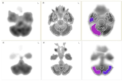 SPECT images show axial slices from a group of 45 retired NFL players compared to 25 normal controls. Purple and violet regions show increasingly abnormal areas of low blood flow (violet represents a larger deficit in blood flow than purple) in the cerebellum and right medial temporal cortex. The medial temporal cortex is frequently implicated in the pathology of Alzheimer's disease. Image courtesy of Dr. Cyrus Raji, PhD.