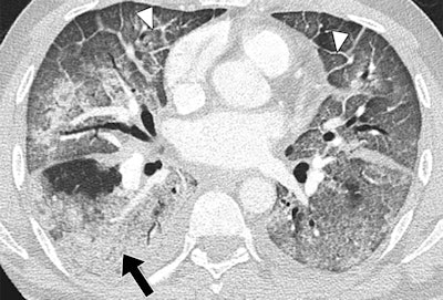 Lower-lung CT image shows more extensive and confluent basal abnormalities, with right lower lobe consolidation (arrow) and bilateral smooth interlobular septal thickening (arrowheads).