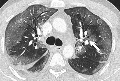 Midlung CT image shows that ground-glass opacities have peribronchovascular distribution (arrow).