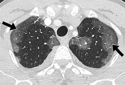44-year-old man with MERS had no prior health problems. CT was performed one day after admission and nine days after symptom onset. The patient died in the intensive care unit. Upper-lung CT image shows large areas of bilateral subpleural ground-glass opacities. All images republished with permission of the American Roentgen Ray Society.