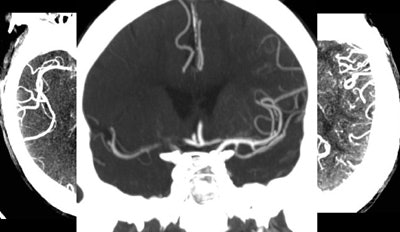 An ischemic stroke patient with a 1-cm hyperdense vessel at CT angiography (not seen) and no visible collateral vessels (above) was visiting a hospital when the stroke occurred. His proximity led to rapid assessment with CT/CTA within 25 minutes, and IV-tPA initiation within an hour of symptom onset. CT showed an M1 vessel occlusion, and CTA revealed a zero collateral pattern, suggesting a large ischemic area. Early treatment was successful, and follow-up CT shows nearly 100% revascularization. Image courtesy of Dr. Michael Lev.