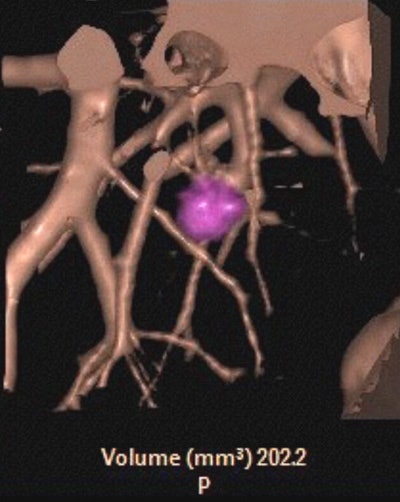 Automated lung nodule volumetry shows a nodule volume of 202.2 mm3. Image courtesy of Dr. Geoffrey Rubin.