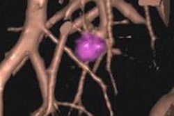 2014 06 19 16 50 40 311 Rubin Lung Nodule 20140619235420