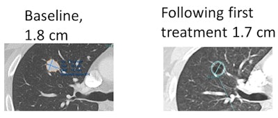 Example of metastatic lung lesion that became cavitary on the first CT following initiation of treatment. Most of the lung lesions in this patient became necrotic to the point of cavitation (commonly seen in this treatment) following the start of therapy. The lesions stayed the same size, however, and some measured larger on axial dimension. All images courtesy of Dr. Les Folio.