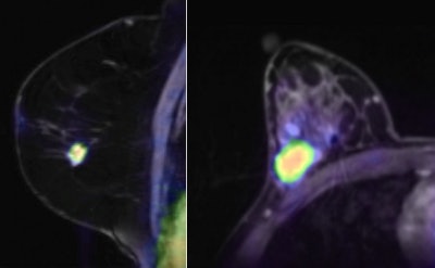 The left image shows invasive ductal carcinoma in a 48-year-old woman. Combined multiparametric F-18 FDG-PET/MRI accurately classifies the lesion as malignant. The irregular spiculated lesion demonstrates initial fast enhancement followed by a washout (BI-RADS 5), restricted diffusivity, and elevated choline levels, and it is highly FDG-avid (not pictured because only the fused PET/MRI image is shown). The right image shows invasive ductal carcinoma in a 39-year-old woman. The oval, circumscribed lesion demonstrates persistent enhancement (BI-RADS 3), restricted diffusivity, and elevated choline levels, and it is highly FDG-avid (again, not pictured). Three of four parameters were indicative of malignancy, and combined multiparametric F-18 FDG-PET/MRI accurately classifies the lesion as malignant. Images courtesy of Dr. Katja Pinker.