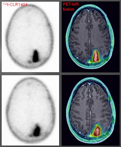 Grade III glioma