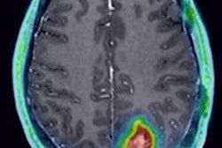 2014 07 01 15 42 27 107 Clr1404 Glioma Right 400 20140701224645