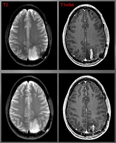 Patient with a grade III glioma is imaged with T2-weighted MRI (above left). Follow-up gadolinium-enhanced MRI (above right) suggested cancer recurrence. CLR1404-PET detected cancer (below left) and fused PET/MRI (below right) delineated the tumor. All images courtesy of Dr. Lance Hall and UW Health.