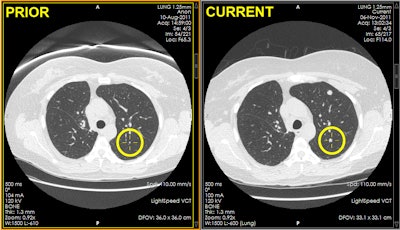 Appearance of PACS display immediately after clicking the automatic deformable registration tool, demonstrating instant location matching of nodules between current and prior studies. Images courtesy of Dr. Matthew Barish.