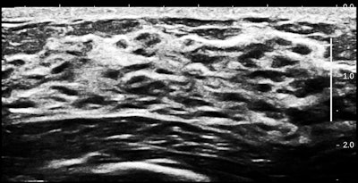 Nipple dichotomy ultrasound