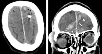 CT images of a 65-year-old man who sustained penetrating neurologic trauma from a ball bearing. Noncontrast CT (left) reveals a spherical metallic density lodged in the left frontal lobe with subarachnoid (arrowhead) and intraparenchymal hemorrhage (arrow). Coronal reformation (right) shows intracranial hemorrhage along the ball bearing's path from the right orbit through the right frontal lobe to the left frontal lobe (arrows). Images courtesy of Radiology.