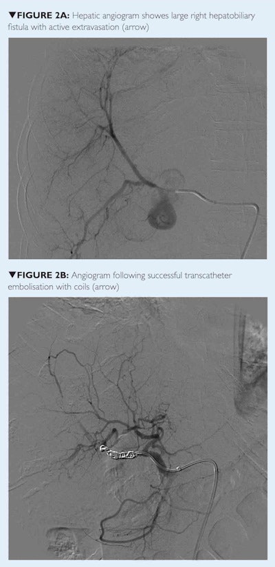 Hepatic angiogram shows fistula