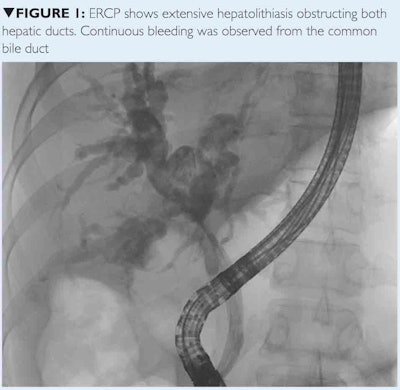 ECRP shows hepatolithiasis
