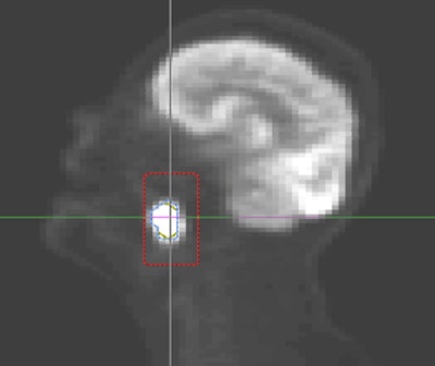 Radiomics evaluates tumor texture