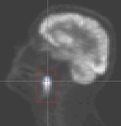 Radiomics evaluates the tumor's size (above) and texture (below). More intense PET images imply the need for more radiation to control the cancer. Images courtesy of Joseph Deasy, PhD, and AAPM.