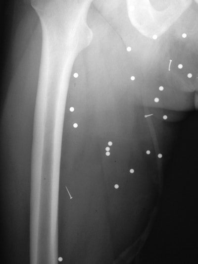 The secondary blast wave propelled multiple ball bearings and nails into the soft tissue of a patient's right thigh.
