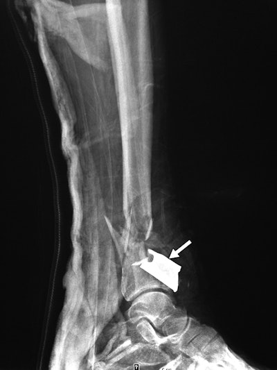 Shrapnel from a secondary blast wave caused a fracture of the distal tibia and fibula in a patient's right leg. All images courtesy of AJR.