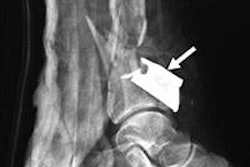 2014 07 29 15 59 17 105 Ajr Shrapnel Leg Larger 400 20140729225944