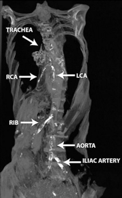 CT image of the mummy of a princess who lived during the Second Intermediate Period of ancient Egypt shows calcifications in the coronary and iliac arteries. She had diffuse atherosclerosis. (This image only is from JACC: Cardiovascular Imaging, April 2011, Vol. 4:4, pp. 315-327.)