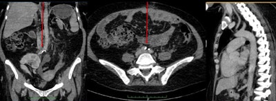 Coronal, axial, and sagittal CT multiplanar reformatted images from a 47-year-old modern Egyptian woman with hypertension but no other risk factors for atherosclerosis. There is mild aortoiliac disease but no coronary or carotid calcium.