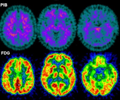 PET of healthy brain