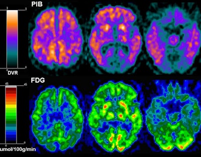 These are sample images (not associated with the study) of PiB-PET and FDG-PET scans from an Alzheimer's patient and a healthy control. The Alzheimer's brain (above) shows large amounts of orange with PiB-PET, indicating higher concentrations of amyloid plaque throughout the brain. With FDG-PET, warmer colors indicate greater glucose uptake, a sign of brain health. The Alzheimer's brain (above) shows less metabolism than the healthy brain (below). Images courtesy of Dr. Ricardo Osorio.