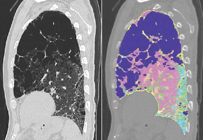 Images are of a 69-year-old man with idiopathic pulmonary fibrosis and emphysema. The patient was a former smoker (45 pack-years). Mean pulmonary artery pressure was 29 mm Hg, measured by right heart catheterization. Above left, computer-aided analysis showed 32.5% emphysema, 16% fibrosis, and 35.7% normal lung tissue volume. Above right and below, sagittal reformatted CT images show computer-aided segmentation results corresponding to the top left image. Pink = normal, dark blue = emphysema, light green = ground-glass opacity, light blue and yellow = fibrosis, dark green = trachea and bronchi, and orange = vessels. Images republished with permission from the American Roentgen Ray Society.