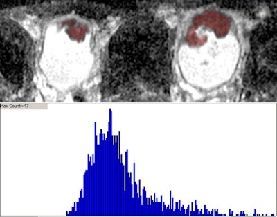 Top of image shows consecutive slices from axial ADC map in patient with an anterior bladder tumor. Red overlay indicates portion of a whole-lesion volume of interest (VOI) encompassing the tumor. Bottom portion shows the histogram from this VOI, which was used to determine the mean, kurtosis, and skewedness of the whole-lesion ADC. Image courtesy of Dr. Andrew Rosenkrantz.