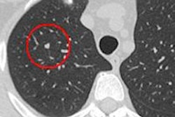 2014 08 18 14 38 46 221 2014 08 19 Rubin Lung Cad 200