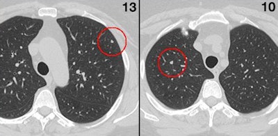 A study of 157 digitally embedded 5-mm nodules showed that radiologists performed poorly in the task of finding nodules without CAD. Overall, 13 readers found only 49% of the clinically relevant lesions. Images courtesy of Dr. Geoffrey Rubin.