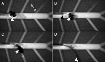 Above, coronal MR images of the MRI-guided catheter deflecting into a branch vessel arising at 60° from the parent vessel. (A) Catheter tip (white arrowhead) became visible by delivery of current to microcoil and (B) deflected instantaneously while the guide catheter (black arrowhead) remained stationary. (C) The interventionalist then advanced the catheter forward to enter a vascular branch angled 60° to the parent vessel, (D) turning off the current once the tip was within the branch vessel and manually advancing the catheter to the edge of the vascular phantom. Image republished with permission from RSNA from Radiology, June 2014, Vol. 271:3, pp. 862-869.
