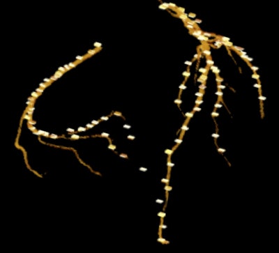 Radiologist-marked center points are superimposed on computer-extracted vessels rendered in 3D volume. Image courtesy of Chuan Zhou, PhD.