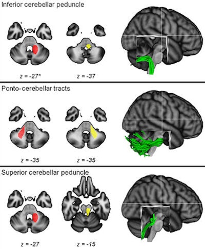 Starting region of interest (ROI) (left images), ending ROI (center images), and dissected white-matter tracts (right images) are superimposed onto a standard T1-weighted MR template. Changes in the left and right superior cerebellar peduncles correlated with balance improvements. Images courtesy of Radiology.