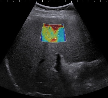 Patient is a 48-year-old man with resolving acute steatohepatitis and cholestasis from alcohol intake with persistent ascites and abnormal liver function tests. Liver biopsy showed stage III fibrosis and 20% steatosis. Shear-wave elastography accurately predicted the presence of significant fibrosis with a shear-wave velocity of 2.83 m/sec at the biopsy site. Image courtesy of Dr. Michael Beland.