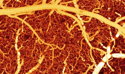 The images show blood flow in a healthy mouse brain versus a mouse brain exposed to cocaine. The image above shows the mouse brain blood vessels before cocaine. The image below shows the blood vessels after cocaine; many of the vessels are now darker, signifying lower blood flow. Field-of-view: 1.2 x 2.0 x 1.0 mm3. Images courtesy of Biomedical Optics Express.