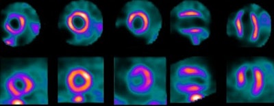 Images of ultralow-dose high-efficiency SPECT (top row) and standard-dose SPECT (bottom row) at rest from a patient at Brigham and Women's Hospital, one of the three sites that participated in the study. Image courtesy of JNM.