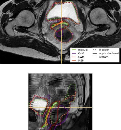 Transversal (top) and sagittal (bottom) view of a moving image overlaid with the propagated delineations of the bladder, applicator, and rectum. Green lines denote the gold standard delineations. Propagated delineations of conventional registration with no applicator mask (CnM), conventional registration with an applicator mask (CwM), and registration including the proposed MSP term (MSP) are shown in purple, red, and orange, respectively.