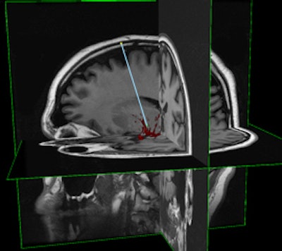 InseRT MRI's software platform is designed to interact with an MRI scanner through a 'portal' being developed by HeartVista. The RTHawk portal controls the operation of the scanner, including image acquisition and reconstruction and tissue visualization. Image courtesy of InseRT MRI.