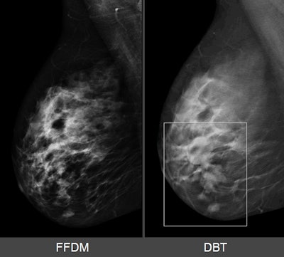 Breast lesion as it appears on 2D mammography (left) and SenoClaire 3D mammography (right). Images courtesy of GE Healthcare.