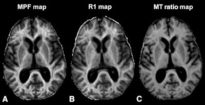 Images show axial sections of 3D MPF, relaxation rate (R1), and magnetization transfer (MT) ratio parametric maps from a 63-year-old woman with secondary-progressive MS. The 3D MPF maps were reconstructed from MT-weighted images and R1 maps. MPF outperforms MT ratio and R1 in detecting MS-related tissue changes. Images courtesy of Radiology.