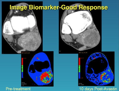 In a sarcoma patient, images before treatment and 10 days later show the treatment is working and should be continued. All images courtesy of Dr. Dushyant Sahani.