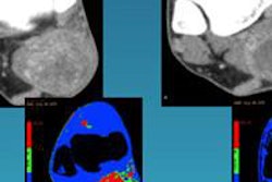 2014 09 12 15 39 54 169 Sahani Sarcoma Tx Response 20140912225144